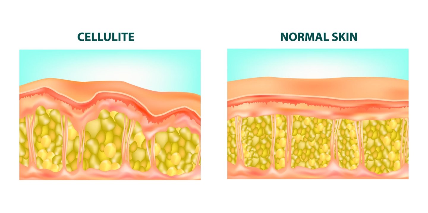 Hoe ontstaat cellulite